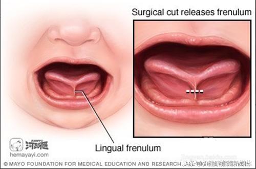 小孩舌头能伸出来是舌系带短吗,舌系带短孩子平翘舌不分怎么办