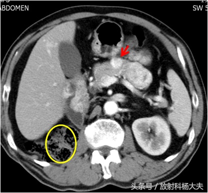 十年前做了胰腺癌手术还会复发吗,肾癌转移到胰腺活多久