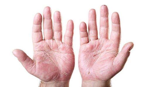手脚脱皮是什么原因造成的,如何处理才好?