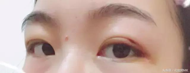 真实贴双眼皮贴,单眼皮怎么贴第二天变双眼皮