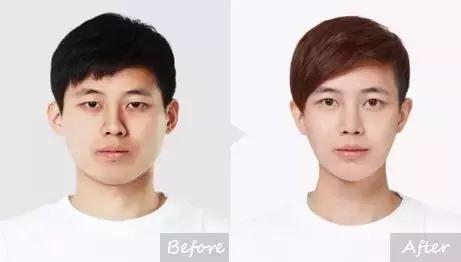 越来越多的男性整形,男士整容变帅案例