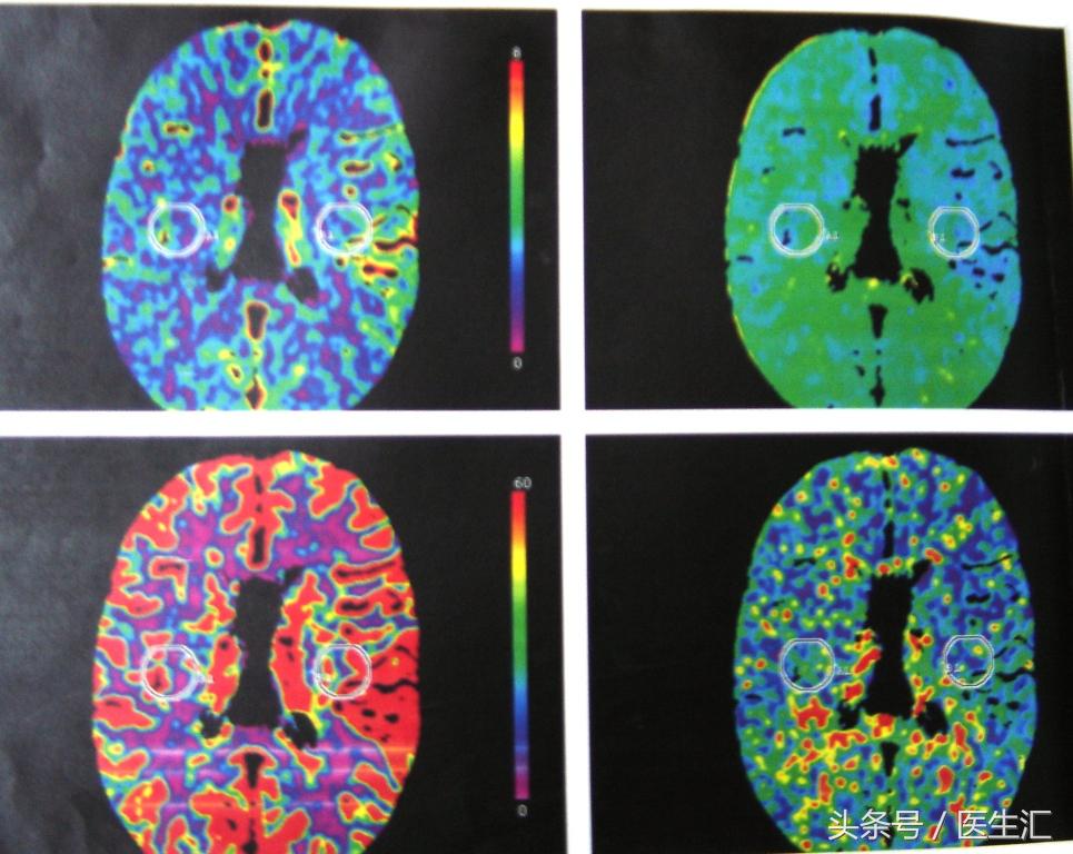脑溶栓治疗一般多少钱,溶栓治疗需要多少费用