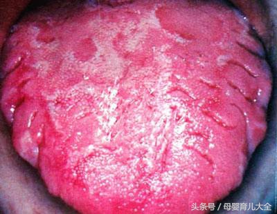 宝宝地图舌是缺维生素吗,11个月宝宝有地图舌