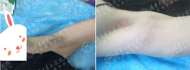 专家讲激光脱毛,激光祛斑现身说法