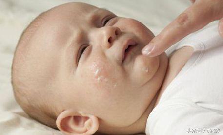 湿疹发病原因,臀部湿疹症状及发病原因