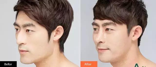 越来越多的男性整形,男士整容变帅案例