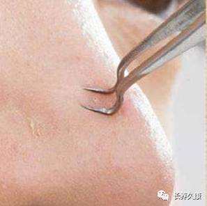 挤痘上瘾怎么办？用这些方法让你再不怕痘痕痘坑！