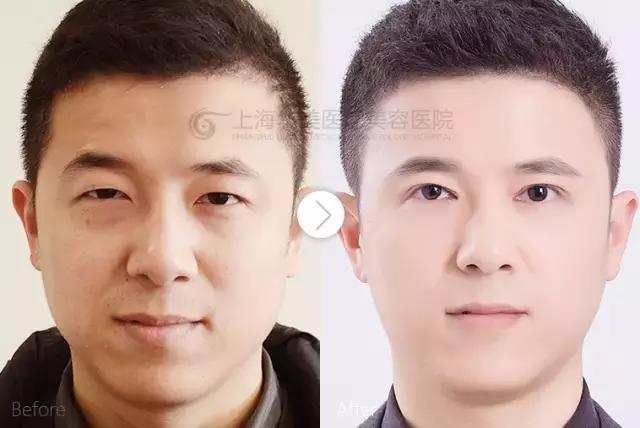 越来越多的男性整形,男士整容变帅案例