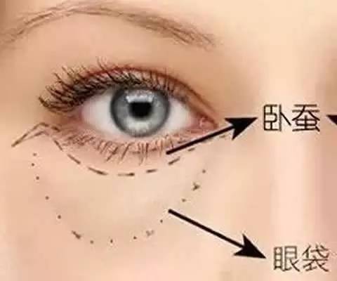 如何分辨自己是眼袋还是卧蚕,这不是眼袋这是卧蚕