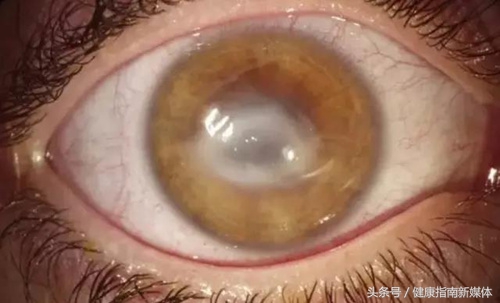 英国妹子用失明的教训告诉你,千万别让隐形眼镜沾上水