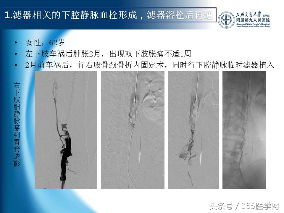 下肢静脉血栓植入滤器后的护理,下肢静脉血栓滤器植入后注意事项