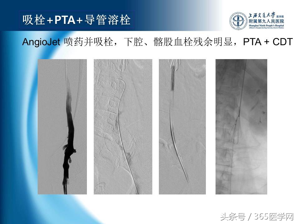 下肢静脉血栓植入滤器后的护理,下肢静脉血栓滤器植入后注意事项
