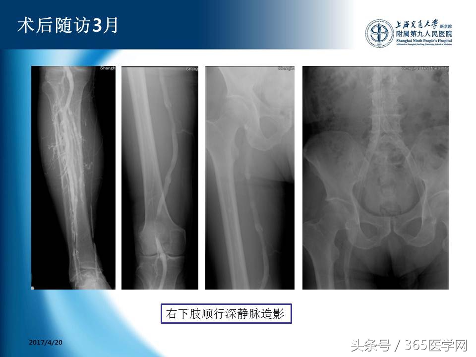 下肢静脉血栓植入滤器后的护理,下肢静脉血栓滤器植入后注意事项