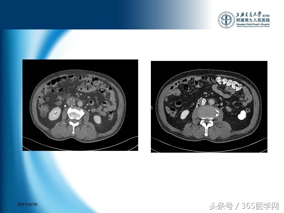 下肢静脉血栓植入滤器后的护理,下肢静脉血栓滤器植入后注意事项