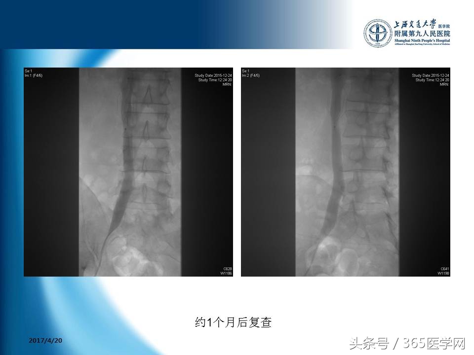 下肢静脉血栓植入滤器后的护理,下肢静脉血栓滤器植入后注意事项