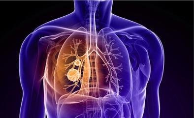 癌症患者必备知识手册有哪些,肺癌化疗药物进口和国产价格