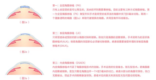 斯里兰卡给中国捐眼角膜,眼角膜移植手术费用医保能报多少