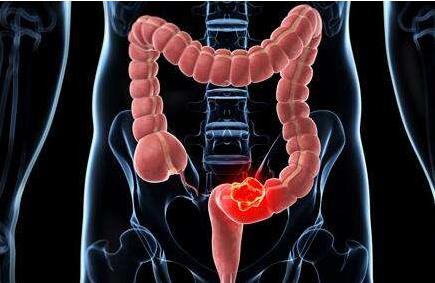 结肠癌的早期5大症状及表现,结肠癌的发展及演变