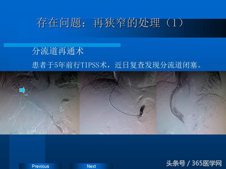 崔进国：消化道出血的介入治疗