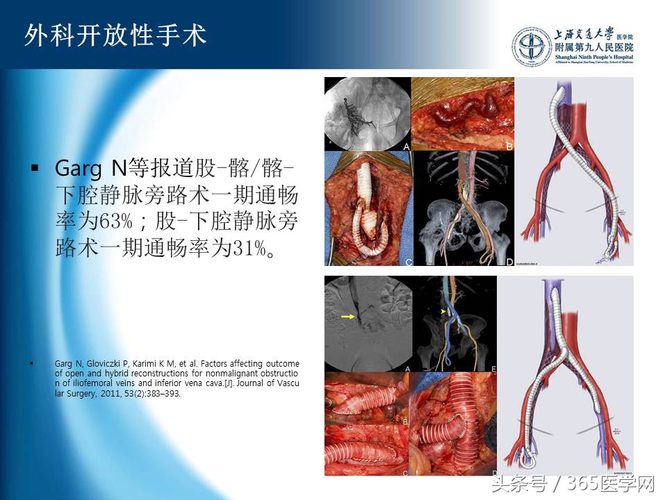 下肢静脉血栓植入滤器后的护理,下肢静脉血栓滤器植入后注意事项