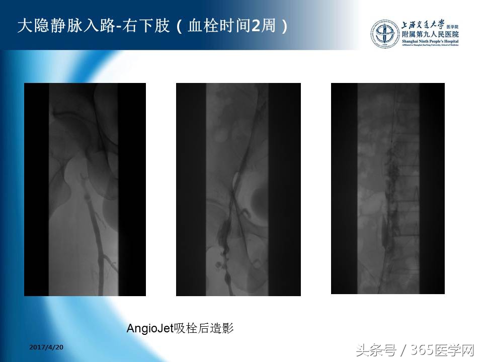 下肢静脉血栓植入滤器后的护理,下肢静脉血栓滤器植入后注意事项
