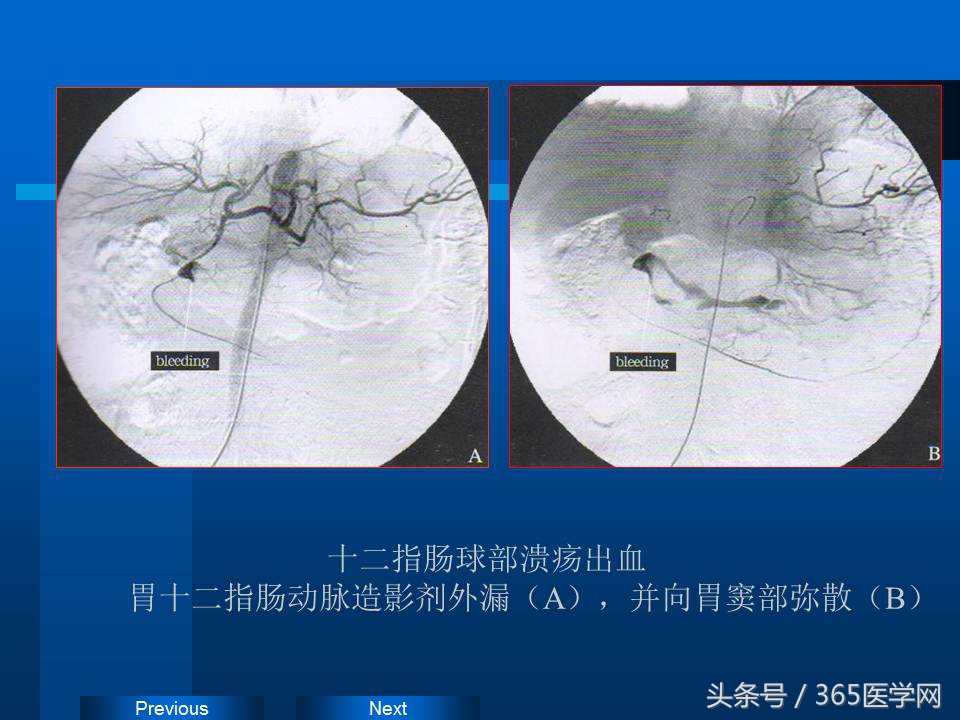 崔进国：消化道出血的介入治疗