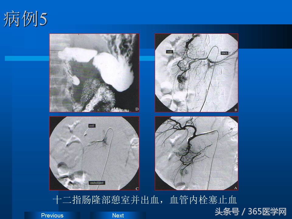 崔进国：消化道出血的介入治疗
