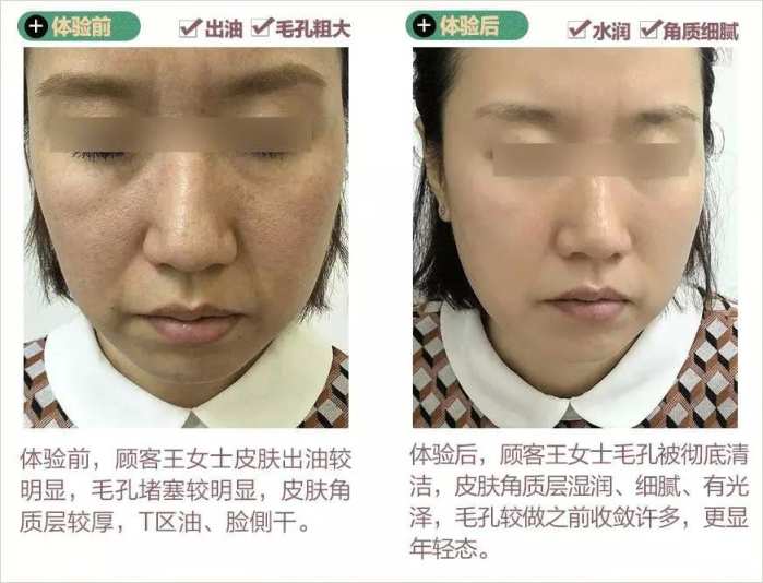 天津美莱超微小气泡洁净毛孔排毒嫩肤