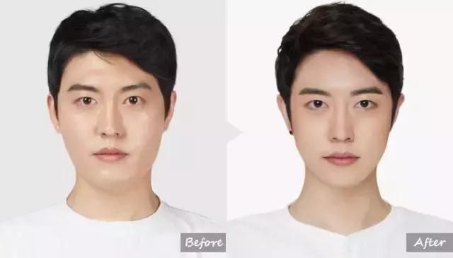 越来越多的男性整形,男士整容变帅案例