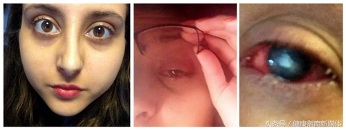 英国妹子用失明的教训告诉你,千万别让隐形眼镜沾上水