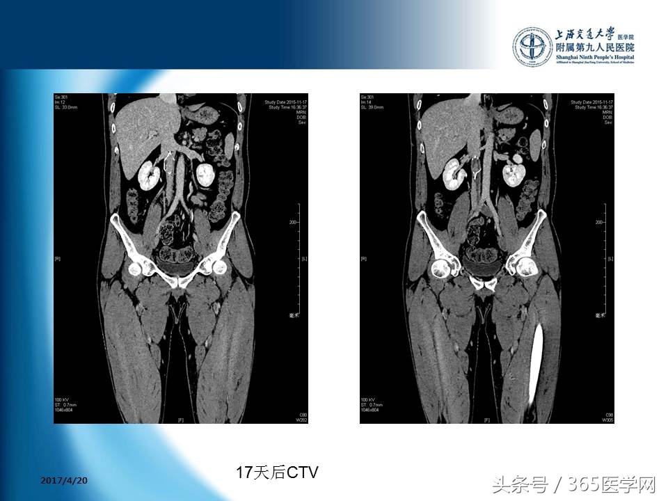 下肢静脉血栓植入滤器后的护理,下肢静脉血栓滤器植入后注意事项