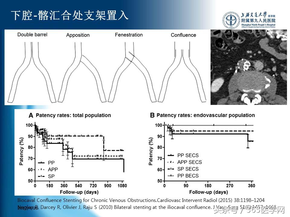 下肢静脉血栓植入滤器后的护理,下肢静脉血栓滤器植入后注意事项