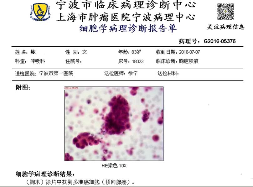 51岁抗击肺癌成功案例,80岁老人肺癌保守治疗案例