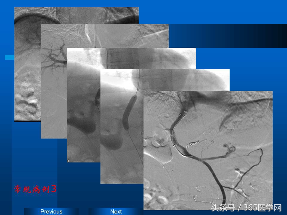 崔进国：消化道出血的介入治疗