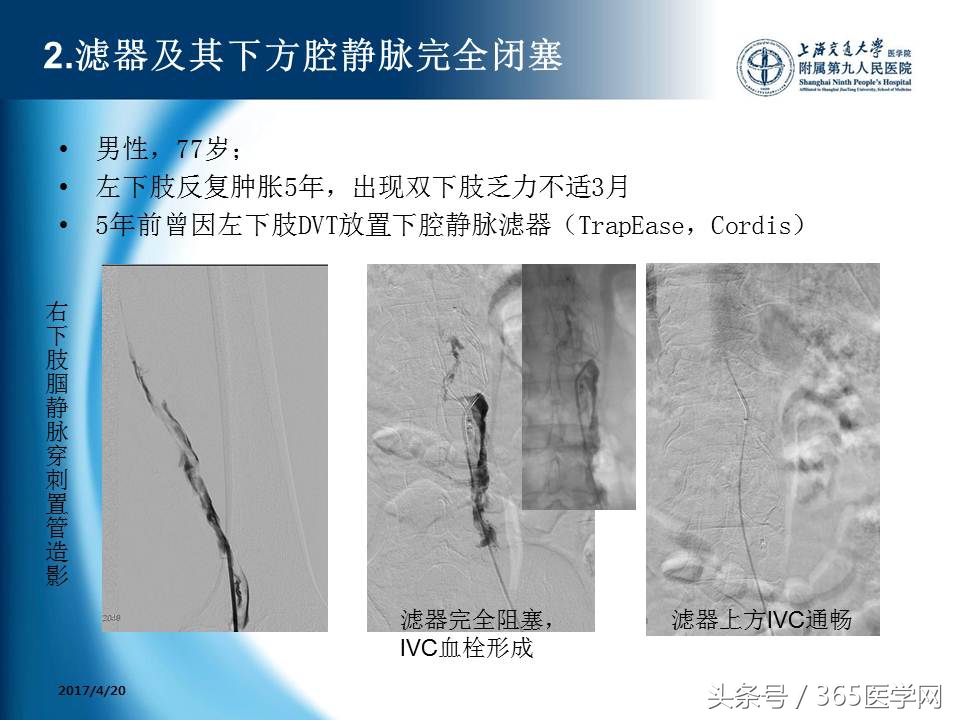 下肢静脉血栓植入滤器后的护理,下肢静脉血栓滤器植入后注意事项