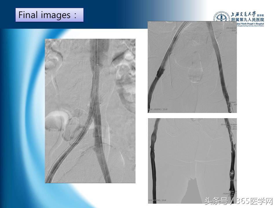 下肢静脉血栓植入滤器后的护理,下肢静脉血栓滤器植入后注意事项