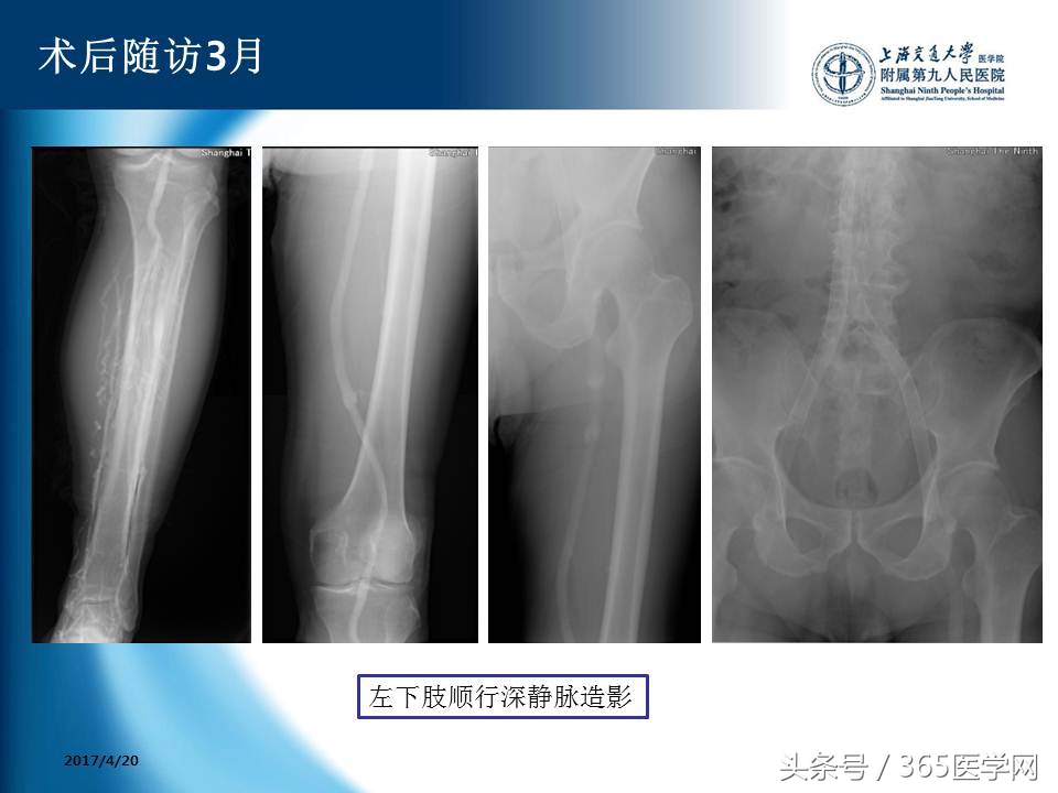 下肢静脉血栓植入滤器后的护理,下肢静脉血栓滤器植入后注意事项