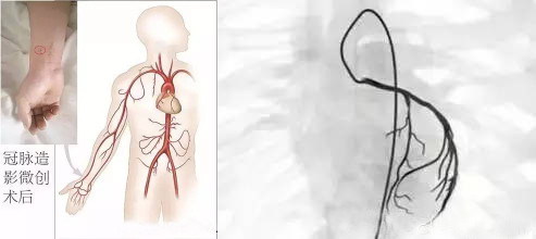 冠脉造影是检查还是治理手段,冠脉造影检查对人体有危害吗