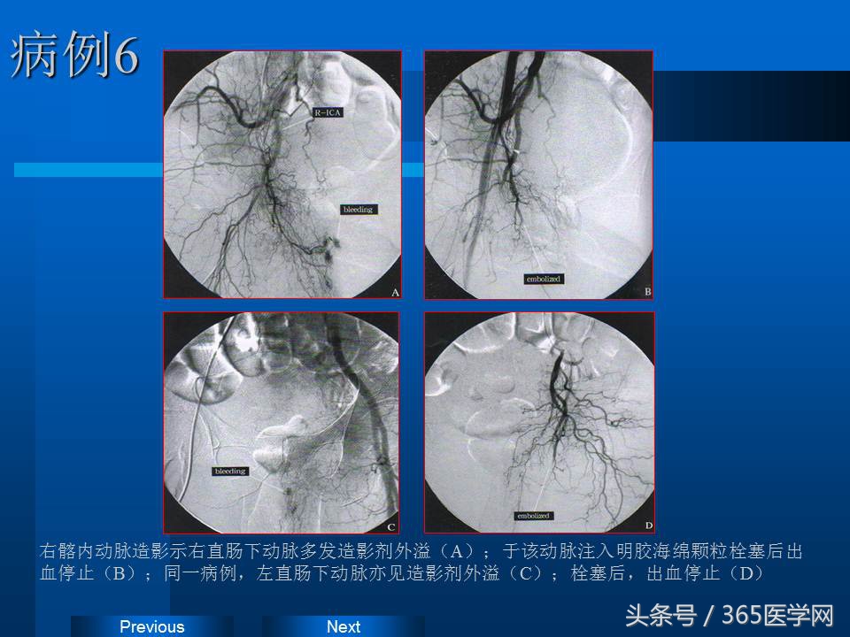 崔进国：消化道出血的介入治疗