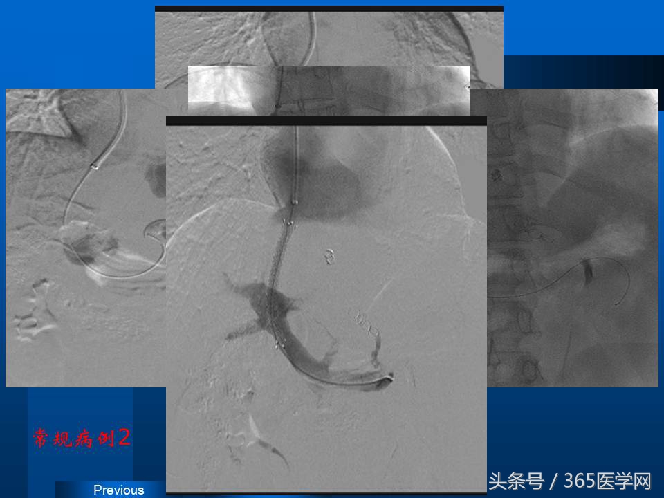 崔进国：消化道出血的介入治疗