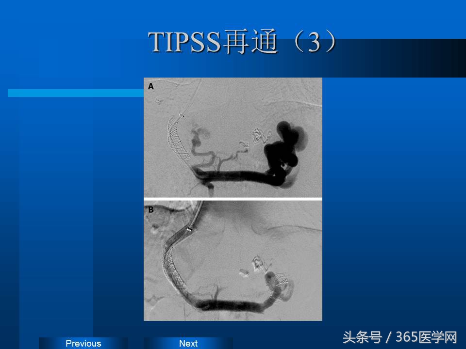 崔进国：消化道出血的介入治疗