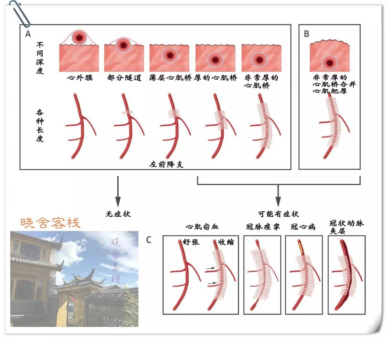 每个人都会有动脉粥样硬化吗,冠状动脉多处心肌桥形成