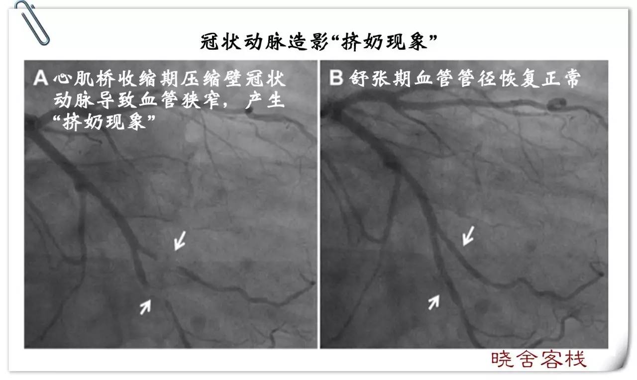 每个人都会有动脉粥样硬化吗,冠状动脉多处心肌桥形成