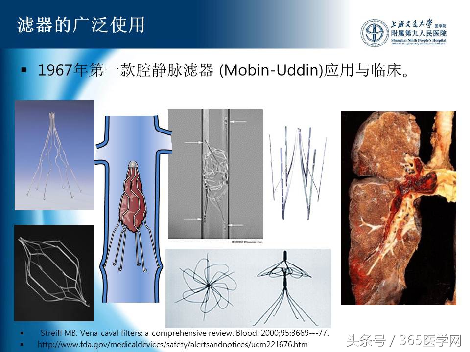 下肢静脉血栓植入滤器后的护理,下肢静脉血栓滤器植入后注意事项