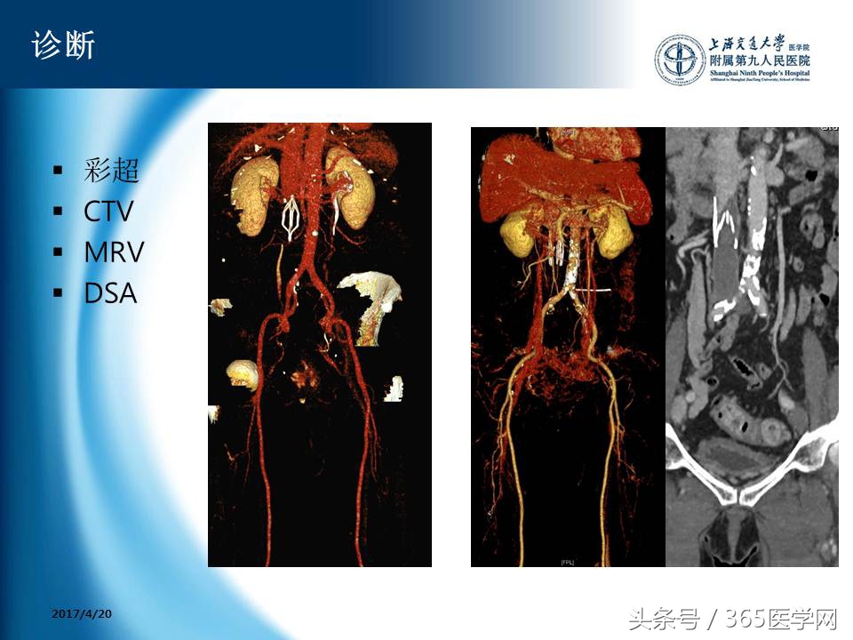 下肢静脉血栓植入滤器后的护理,下肢静脉血栓滤器植入后注意事项