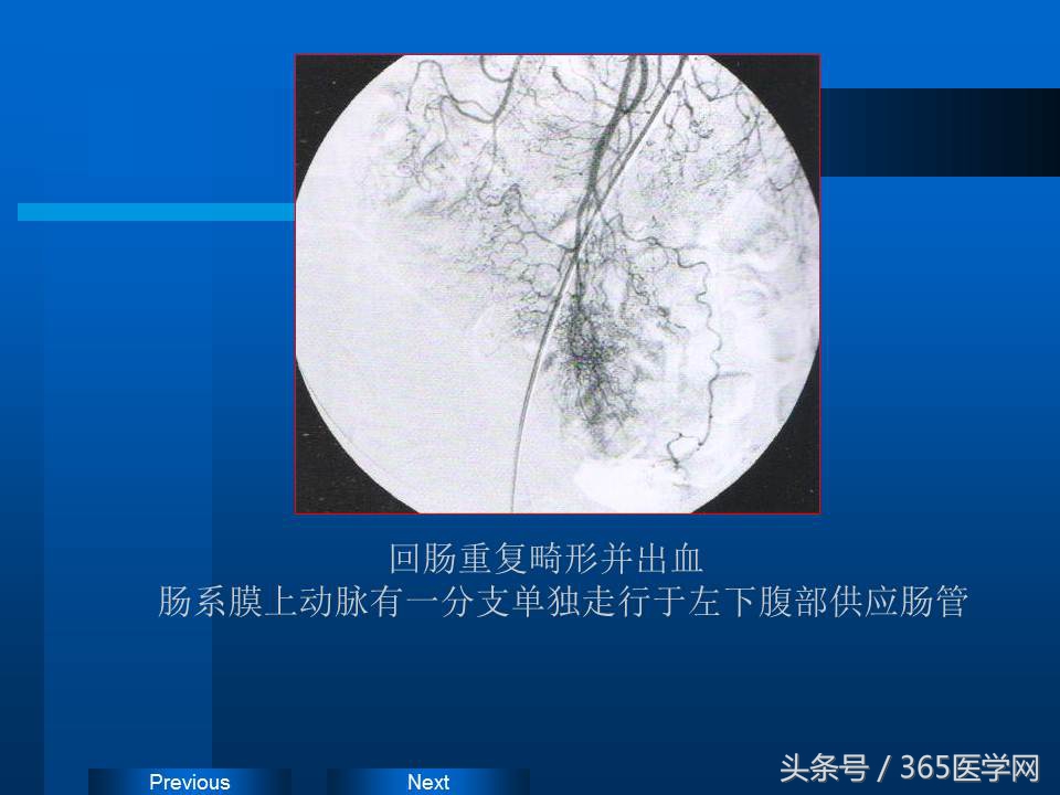 崔进国：消化道出血的介入治疗