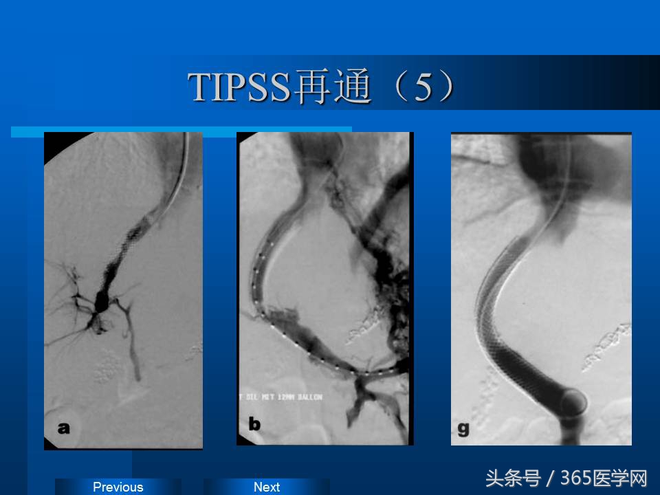 崔进国：消化道出血的介入治疗