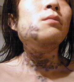 蔓状血管瘤是瘤还是血管畸形,混合血管瘤和血管畸形的区别