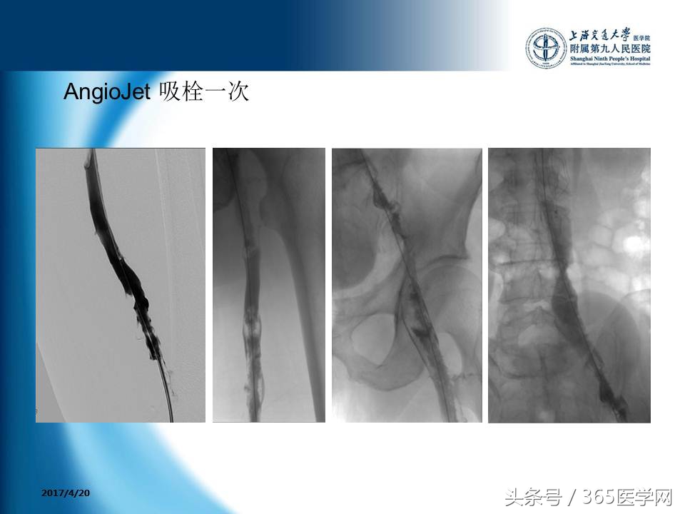 下肢静脉血栓植入滤器后的护理,下肢静脉血栓滤器植入后注意事项