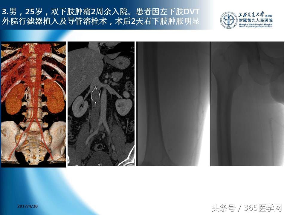 下肢静脉血栓植入滤器后的护理,下肢静脉血栓滤器植入后注意事项